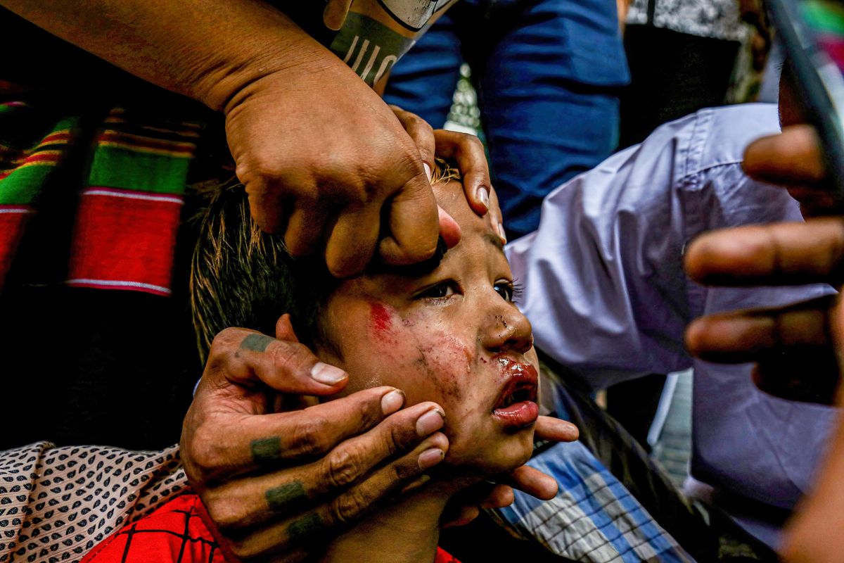 A bruised child slingshoted by soldiers hiding his their truck during an anti-coup demonstration. Myanmar Security Forces shot at anti-military coup protesters and those close to them with slingshots, rubber bullets and other materials thus injuring young children and many were arrested