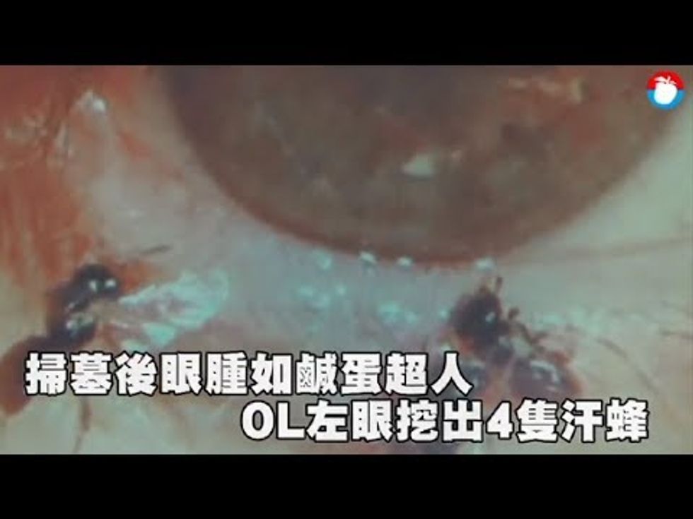 Doctors find bees in Taiwanese woman's eye, feeding on her tears